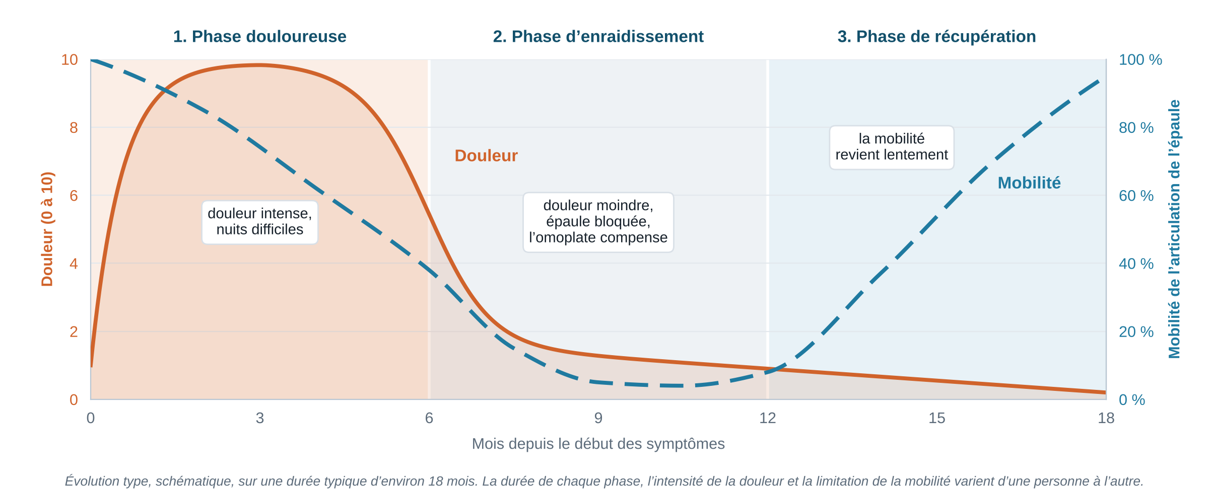 Évolution type de la douleur et de la mobilité de l’épaule au cours des 3 phases de la capsulite rétractile